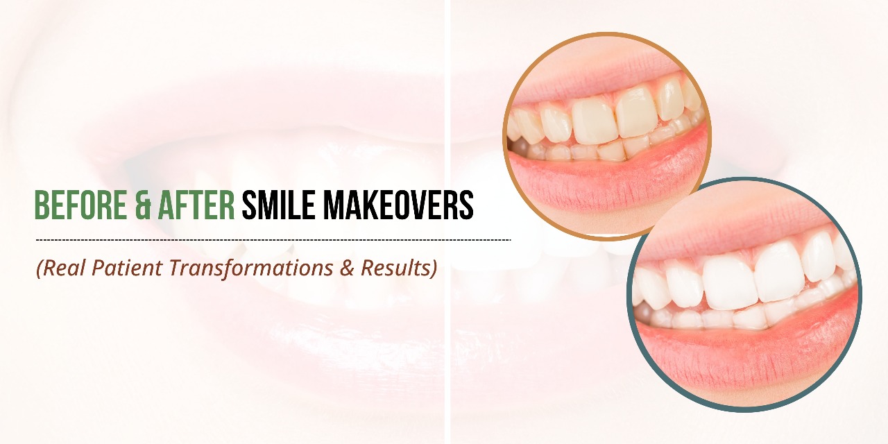 Before-and-after-smile-makeover-showing-brighter-straighter-teeth-and-enhanced-confidence-through-modern-cosmetic-dental-care